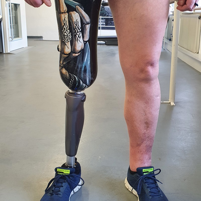 Knieex Prothese mit Design Vakuumschaft und elektonisch gesteuerten Kniegelenk